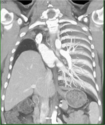 Right Pneumonectomy - CTisus CT Scan