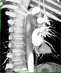 Prominent Intercostal Arteries - CTisus CT Scan