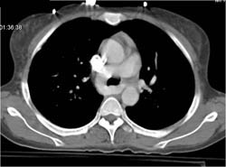 Pulmonary Artery Sling - CTisus CT Scan