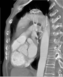 Arch Aneurysm - CTisus CT Scan