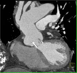 Aortic Valve Replacement and Ascending Aorta Repair - CTisus CT Scan