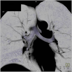 Stenosis Right Lower Lobe Bronchus - CTisus CT Scan