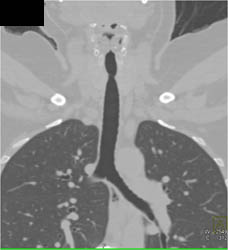 Virtual Bronchoscopy With Tracheal Stenosis - CTisus CT Scan