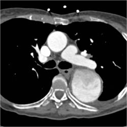 Aneurysm Descending Aorta With Ulceration - CTisus CT Scan