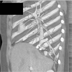 Partial Anomalous Pulmonary Venous Return- PAPVR - CTisus CT Scan