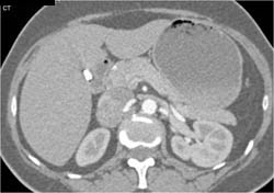 Splenosis - CTisus CT Scan