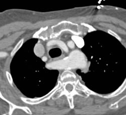 Aneurysm of Aberrant Left Subclavian Artery - CTisus CT Scan