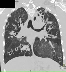 Cystic Fibrosis - CTisus CT Scan