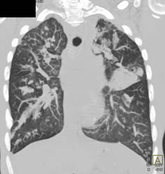 Cystic Fibrosis - CTisus CT Scan