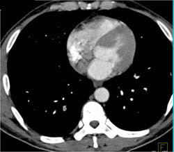 Hepatoma Invades the Inferior Vena Cava (IVC) - CTisus CT Scan