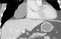 Pericardial Cyst - CTisus CT Scan