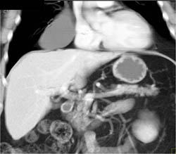 Pericardial Cyst - CTisus CT Scan