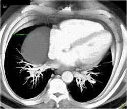 Pericardial Cyst - CTisus CT Scan