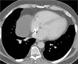 Pericardial Cyst - CTisus CT Scan