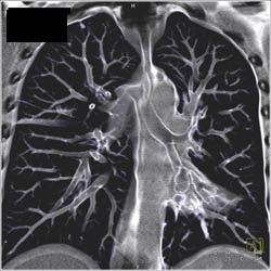 Left Lower Lobe- Bronchiectasis on Virtual Bronchoscopy - CTisus CT Scan