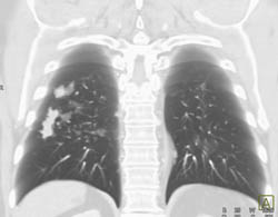 Mucoid Impaction - CTisus CT Scan