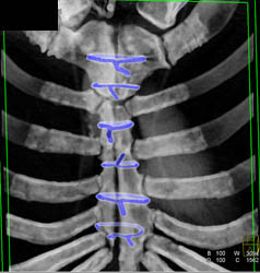 S/P Medial Sternotomy - CTisus CT Scan