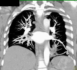 Sequestration in Left Lower Lobe - CTisus CT Scan