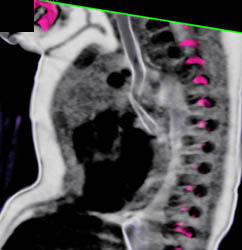 Airway Compression By Double Arch - CTisus CT Scan