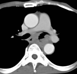 T-e Fistulae Due to Lung Cancer - CTisus CT Scan