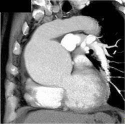 Dilated Aortic Root - CTisus CT Scan