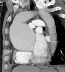 Dilated Aortic Root - CTisus CT Scan