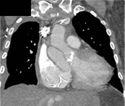 Pseudoaneurysm of Root of Aorta - CTisus CT Scan