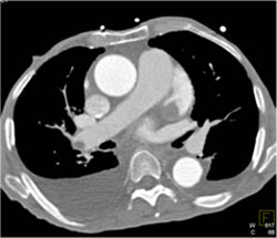 Pulmonary Embolism - CTisus CT Scan