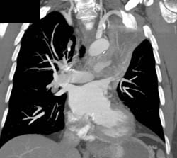 Left Upper Lobe Collapse Due to Lung Cancer - CTisus CT Scan