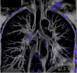 Bronchiectasis - CTisus CT Scan