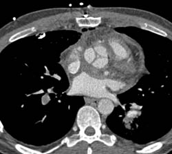 Pulmonary Embolism - CTisus CT Scan