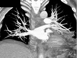 Pulmonary Embolism - CTisus CT Scan