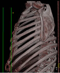 Pectus Deformity - CTisus CT Scan