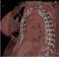 Pectus Deformity - CTisus CT Scan