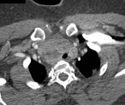 Substernal Thyroid and Left SVC - CTisus CT Scan