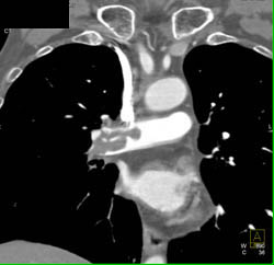 Pe - CTisus CT Scan