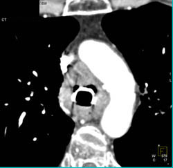 Tracheal Stenosis With Stent and Pe - CTisus CT Scan