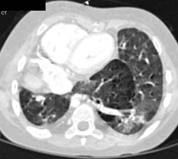 Horseshoe Lung- Note Both Lungs Communicate in the Mid-line - CTisus CT Scan