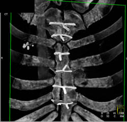 Post Sternotomy - CTisus CT Scan