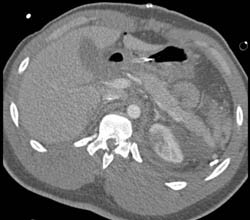 Trauma With Renal and Diaphragm Injury - CTisus CT Scan