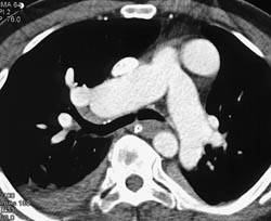 Enlarged Pulmonary Arteries With Pulmonary Hypertension - CTisus CT Scan