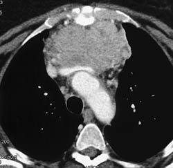 Thymoma - CTisus CT Scan