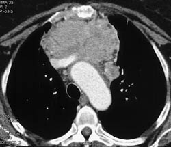 Thymoma - CTisus CT Scan