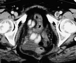 Pulmonary Embolism (PE) With Deep Vein Thrombosis (DVT) - CTisus CT Scan