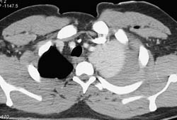 Ruptured Diaphragm With Intrathoracic Stomach - CTisus CT Scan