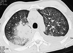 Aspergillosis Lung - CTisus CT Scan