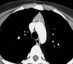 Enlarged Thymus in 35 Year Old Male - Chest Case Studies - CTisus CT ...