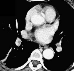 Pulmonary Embolism (PE) and Deep Vein Thrombosis (DVT) - CTisus CT Scan