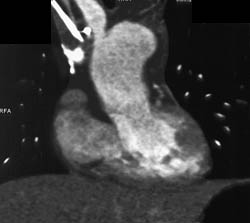 Clot in SVC - CTisus CT Scan