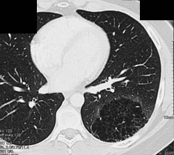 Sequestration in Left Lower Lobe - CTisus CT Scan